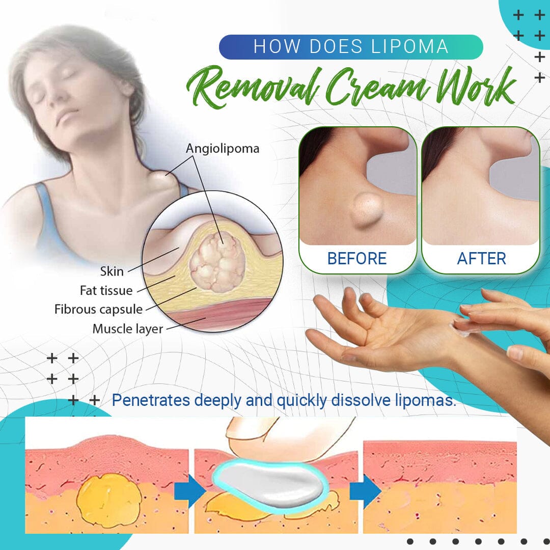 LumpFree Lipoma Removal Cream