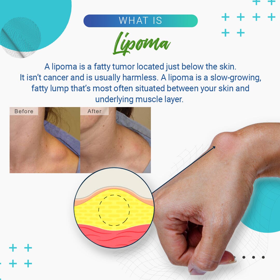 LumpFree Lipoma Removal Cream