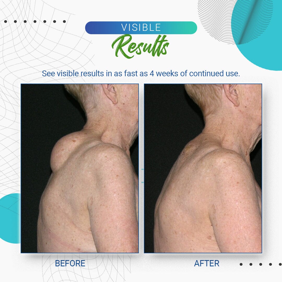 LumpFree Lipoma Removal Cream