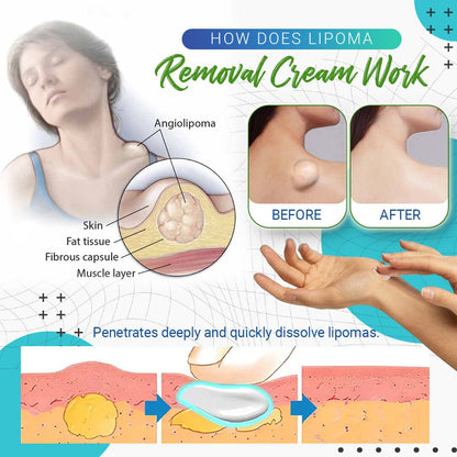 LumpFree Lipoma Removal Cream